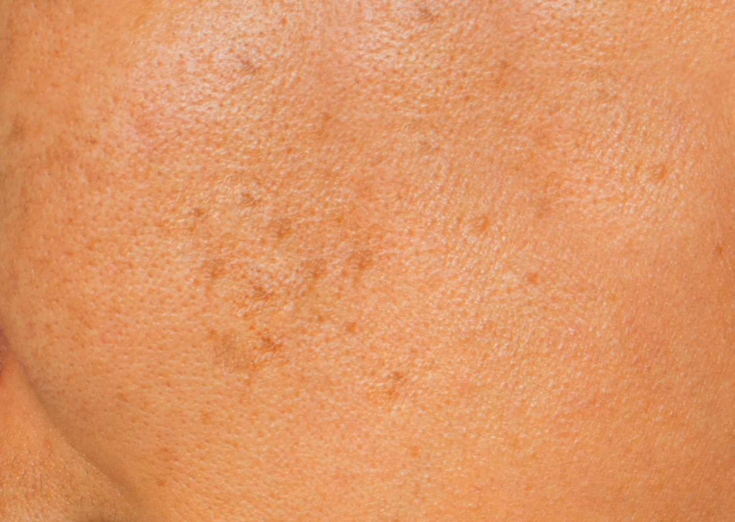 Close-up of skin with hyperpigmentation, illustrating the top 10 ingredients to fade dark spots and even skin tone