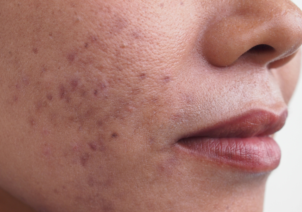 Side profile of a face with visible hyperpigmentation, showcasing the appearance of this common skin concern