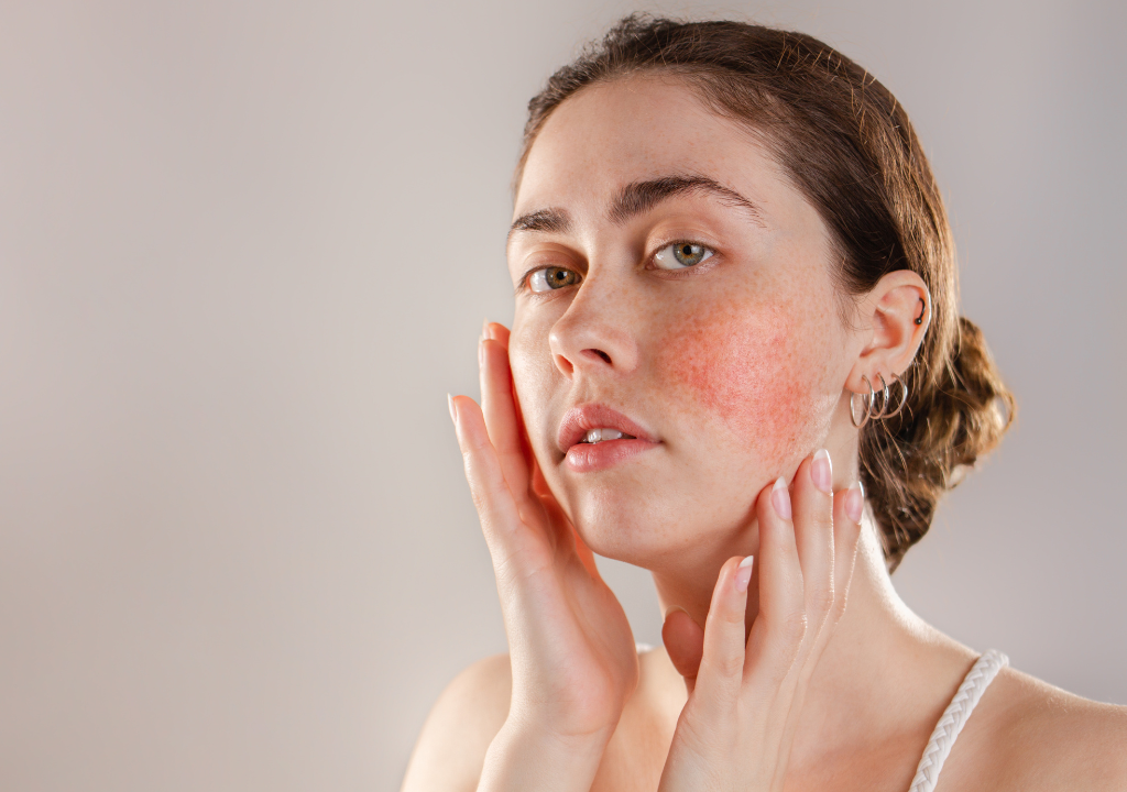 Woman with visible rosacea touching her cheeks, featuring article covering various rosacea triggers