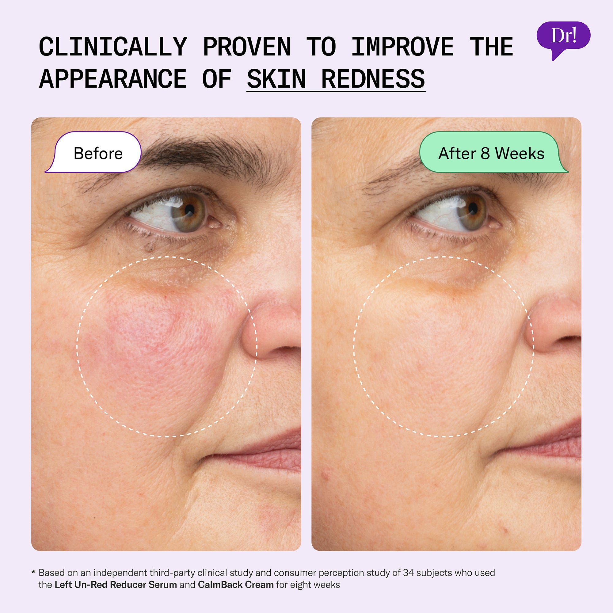 Before and after showing improved appearance of facial redness after 8 weeks using Left Un-Red CalmBack Cream + Reducer Serum