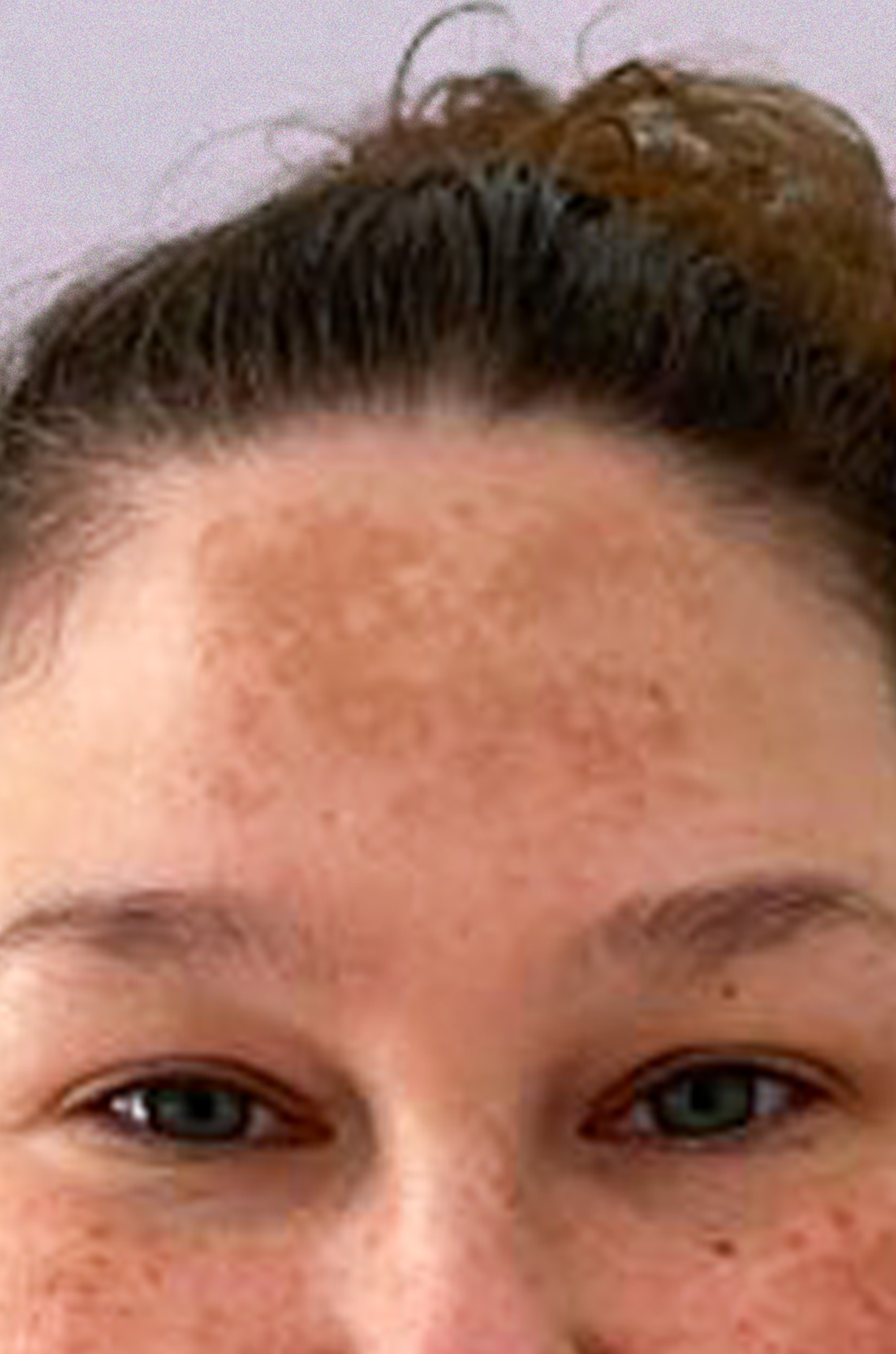 Showing a customer's dark spots and hyperpigmentation before starting Major Fade
