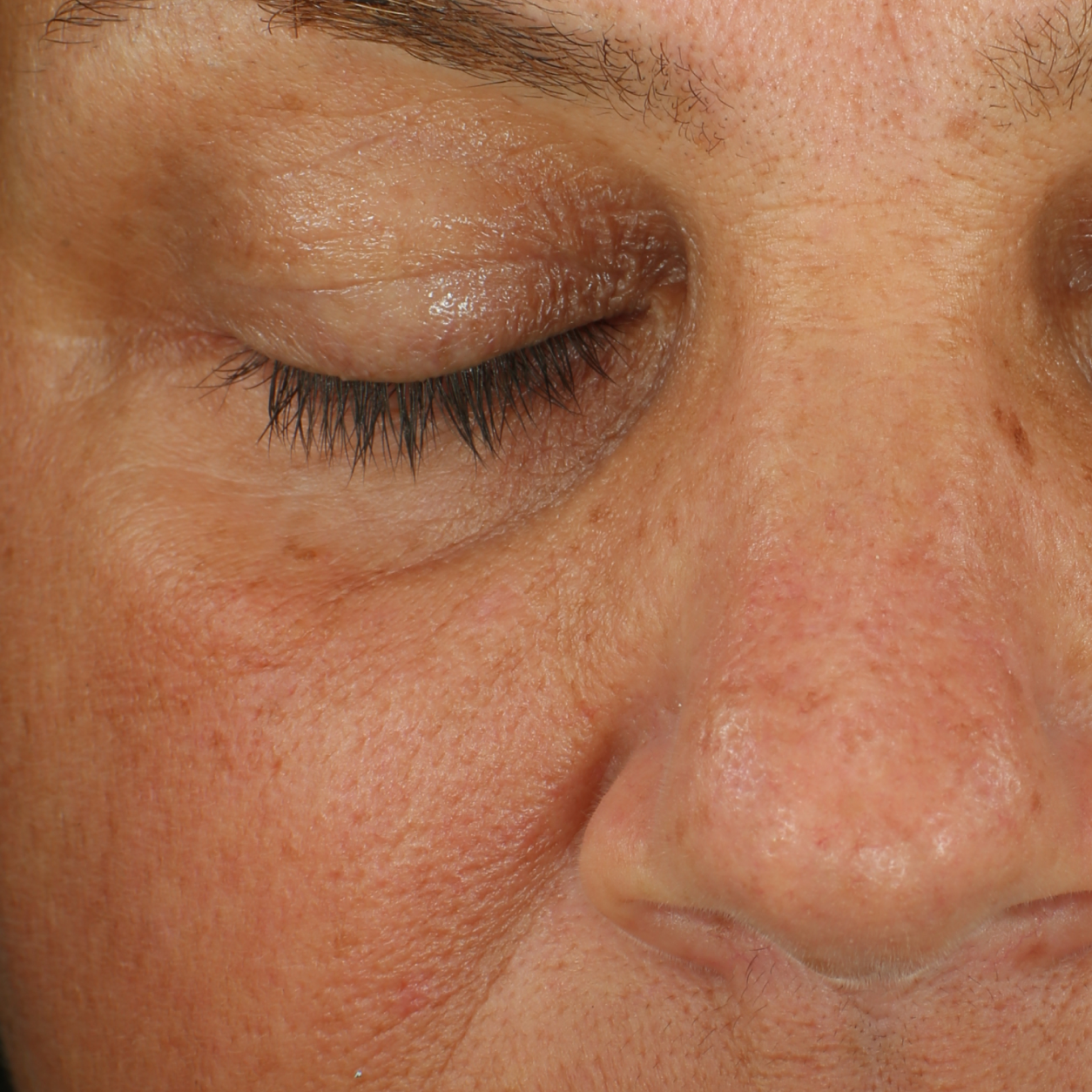 Clinical results for The Depuffer, before image