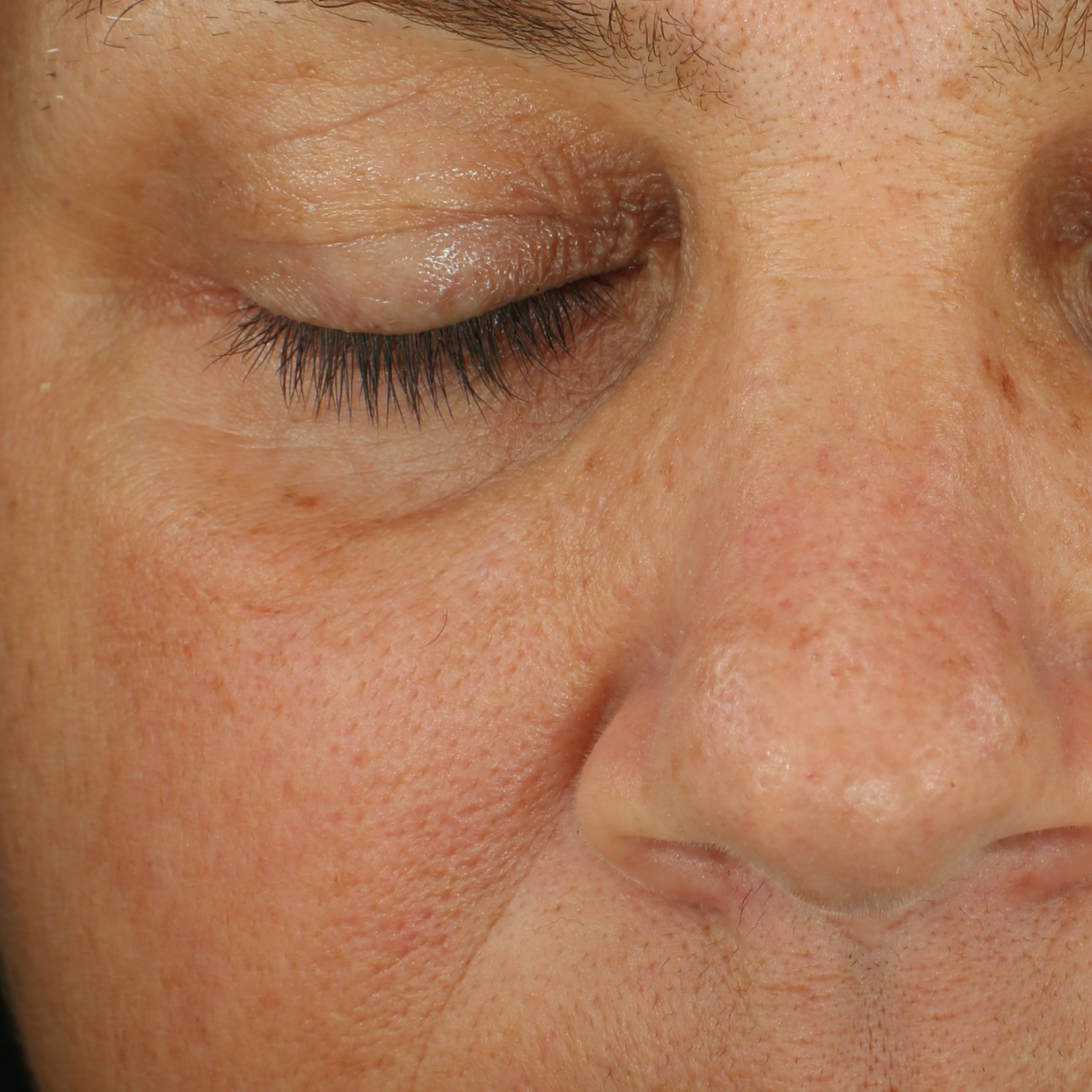 Clinical results for The Depuffer showing a visible improvement in undereye puffiness and redness after 4 weeks