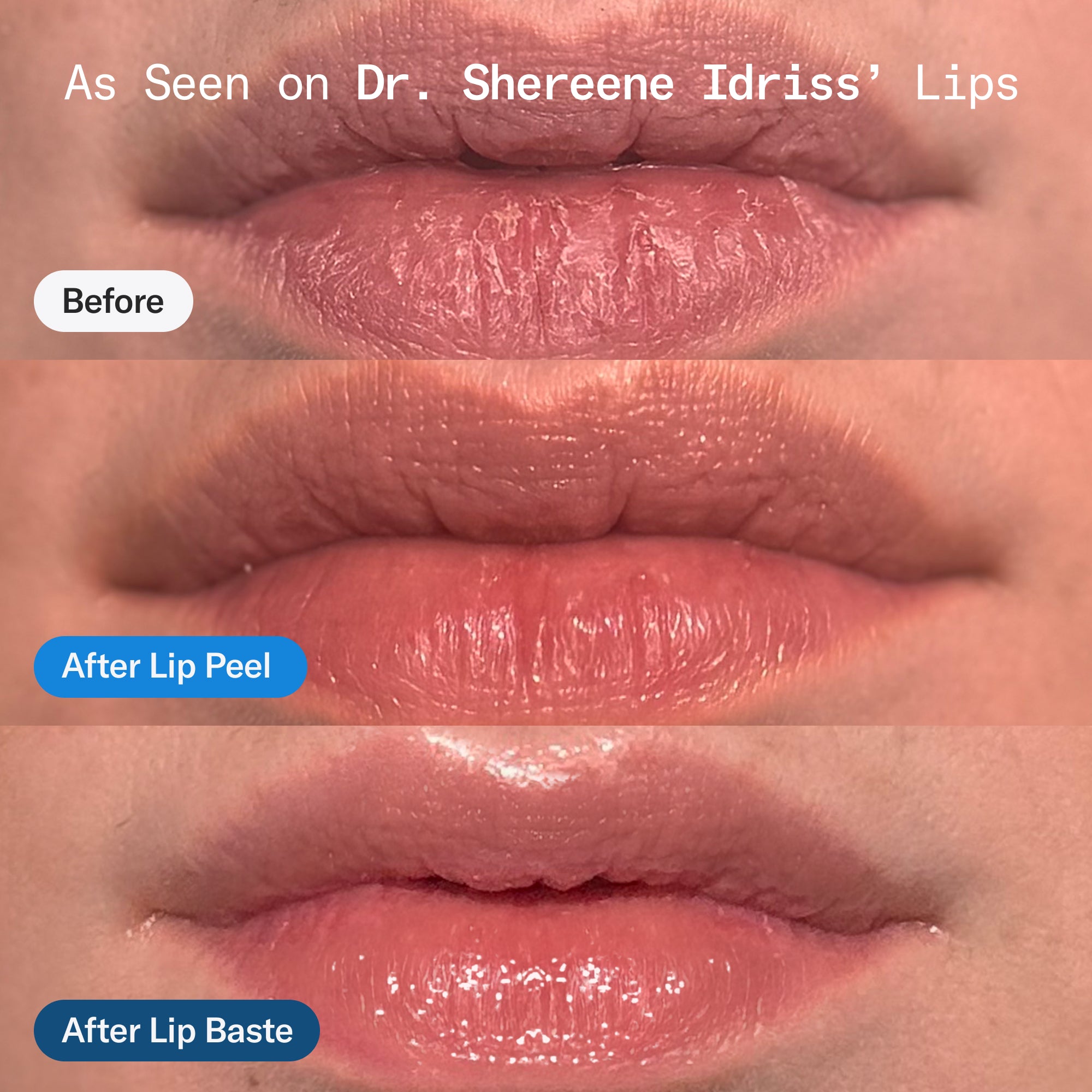 Before and After the lip duo on Dr. Shereene's lips