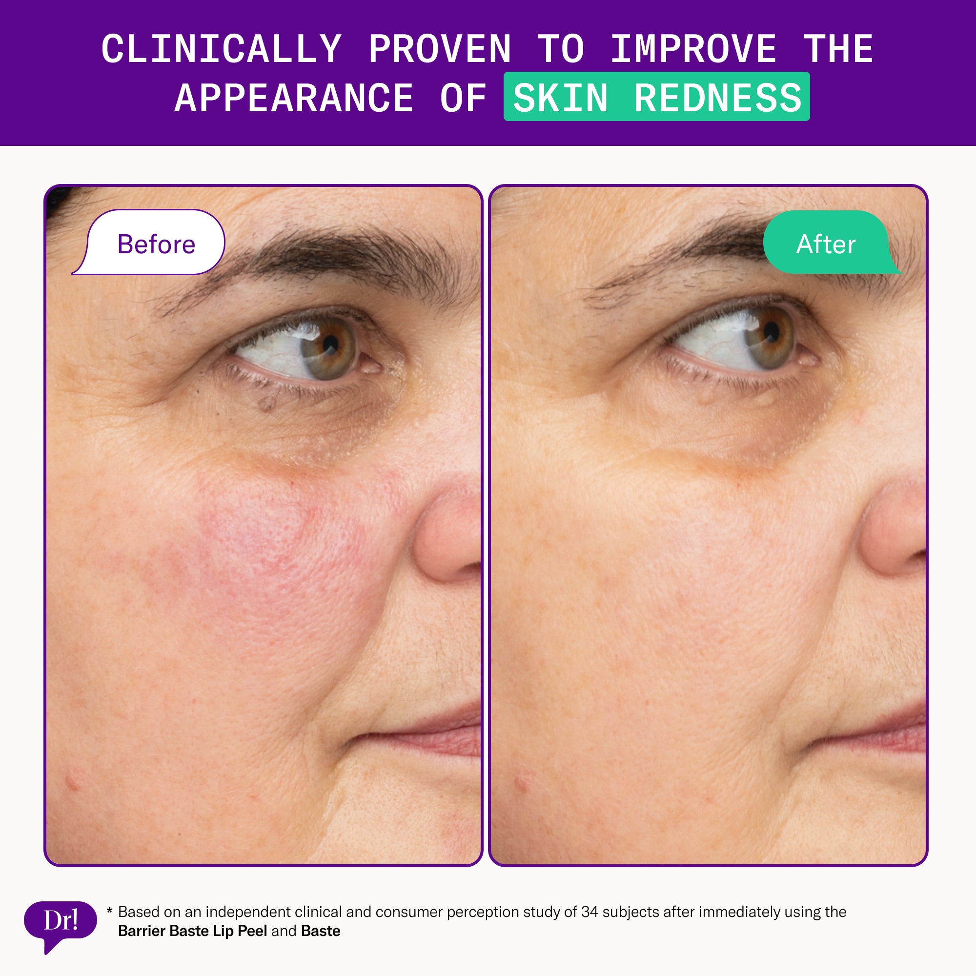 Before and after results showing reduced visible facial redness after using Left Un-Red skincare