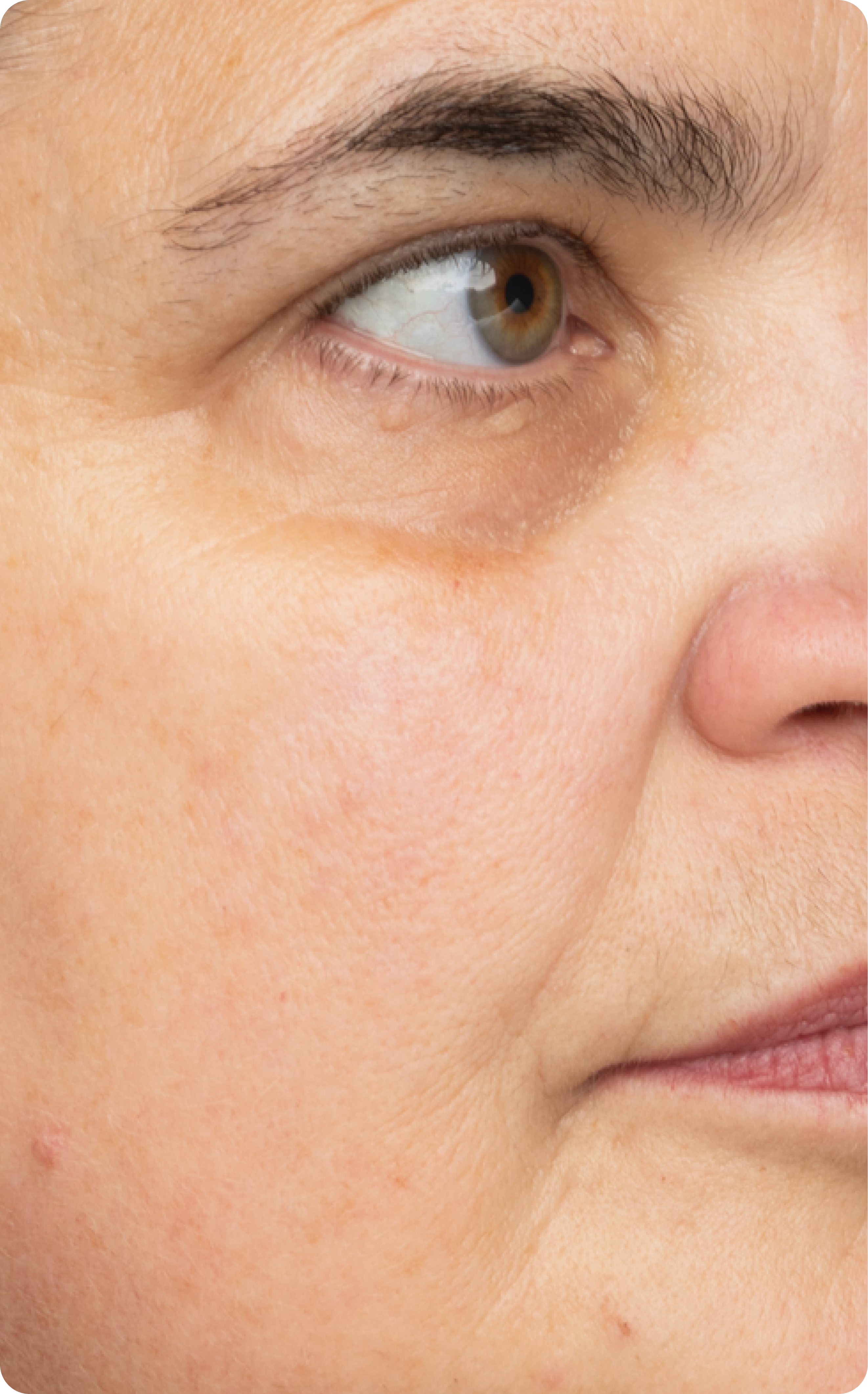 woman with improved visible redness after using Left Un-Red for 8 weeks