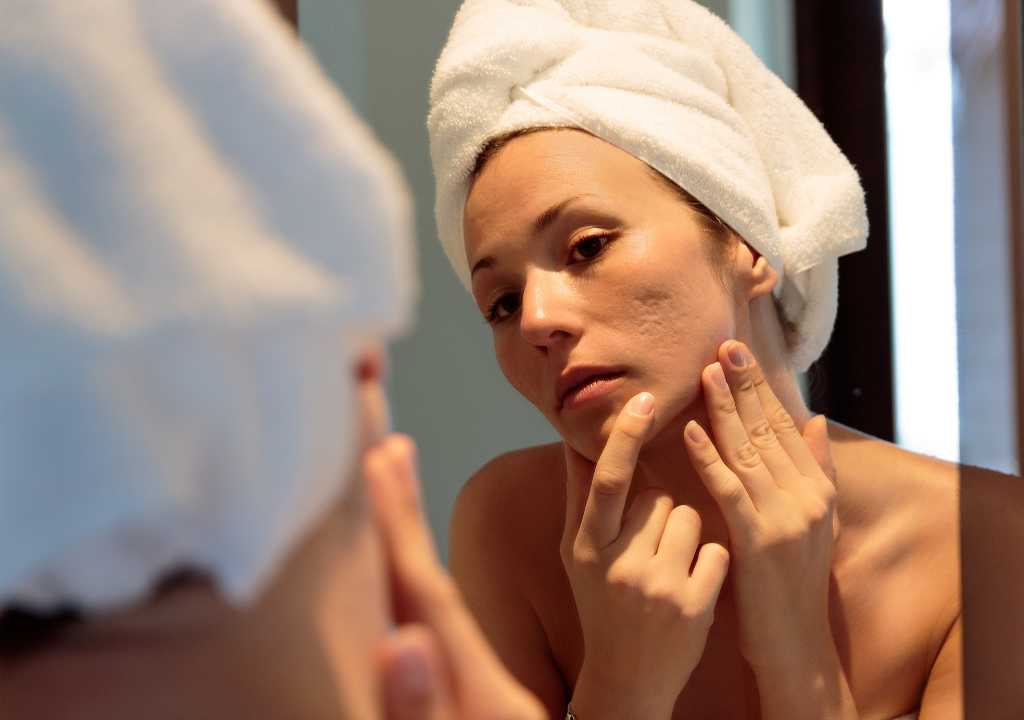 Woman examining her skin in the mirror, wearing a towel on her head, featuring an article addressing skincare for acne scars