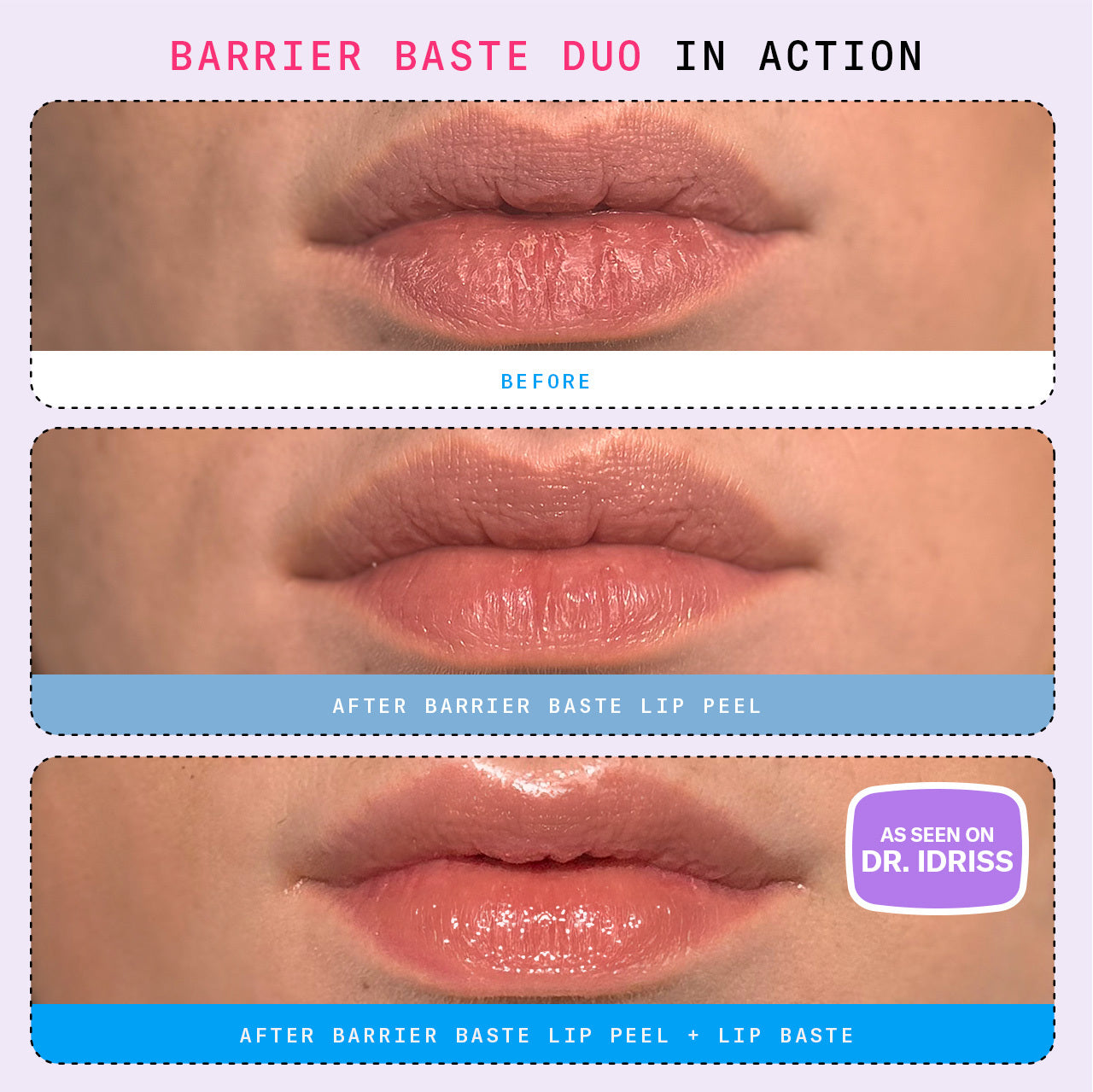 Before and After diagram showing use of Barrier Baste Lip Peel and Lip Baste