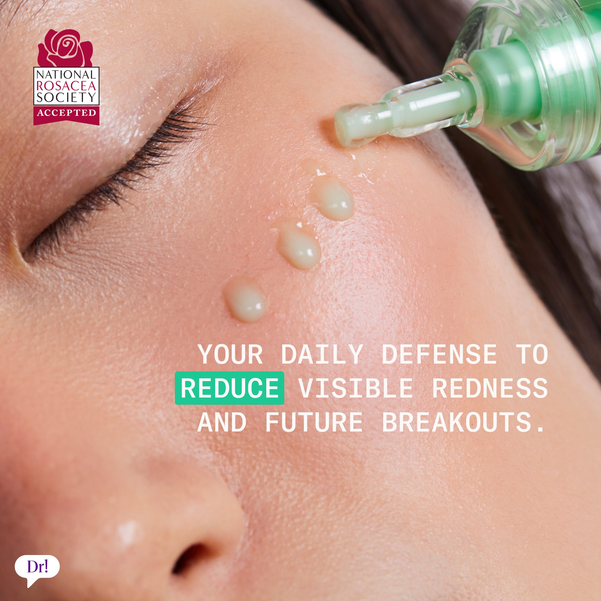 Left Un-Red Reducer Serum applied to skin to visibly reduce redness and future breakouts