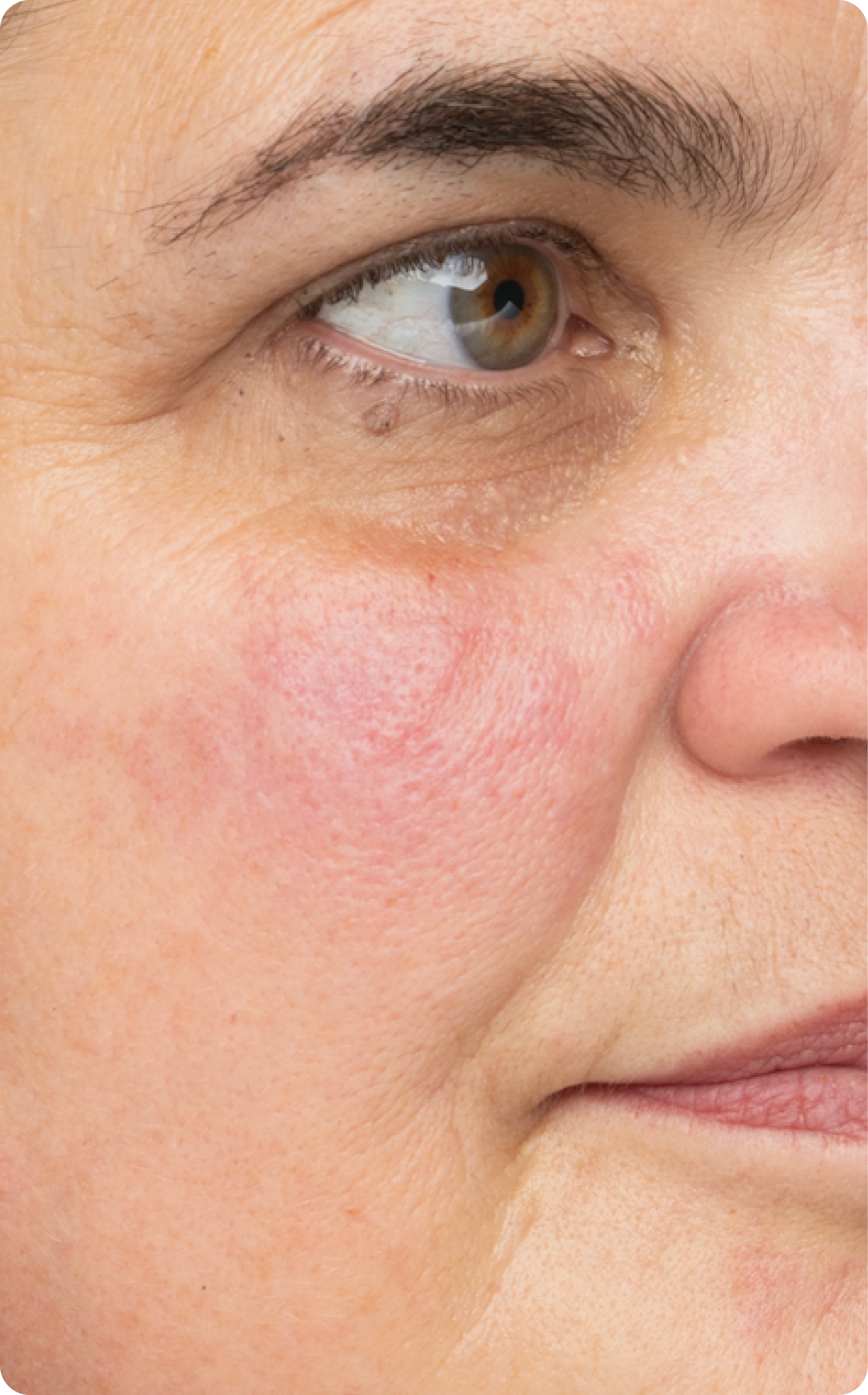 woman with redness on her cheek, before using Left Un-Red