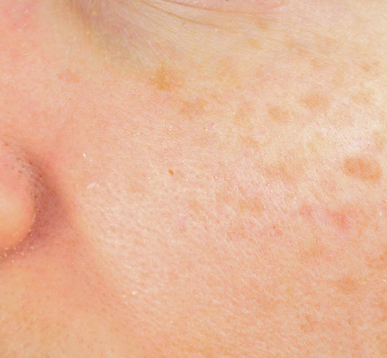 [dark spots] and uneven skin tone