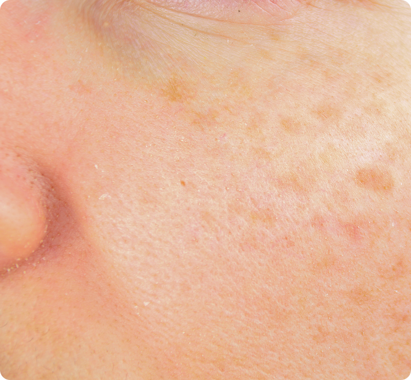 image showcasing dark spots and uneven skin tone