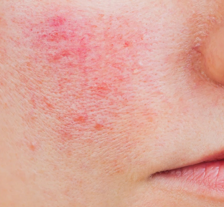 [redness] and flushing
