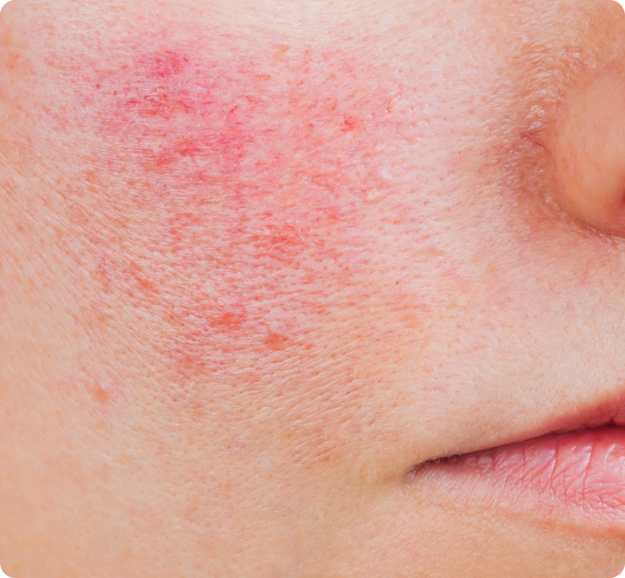 Redness & Flushing