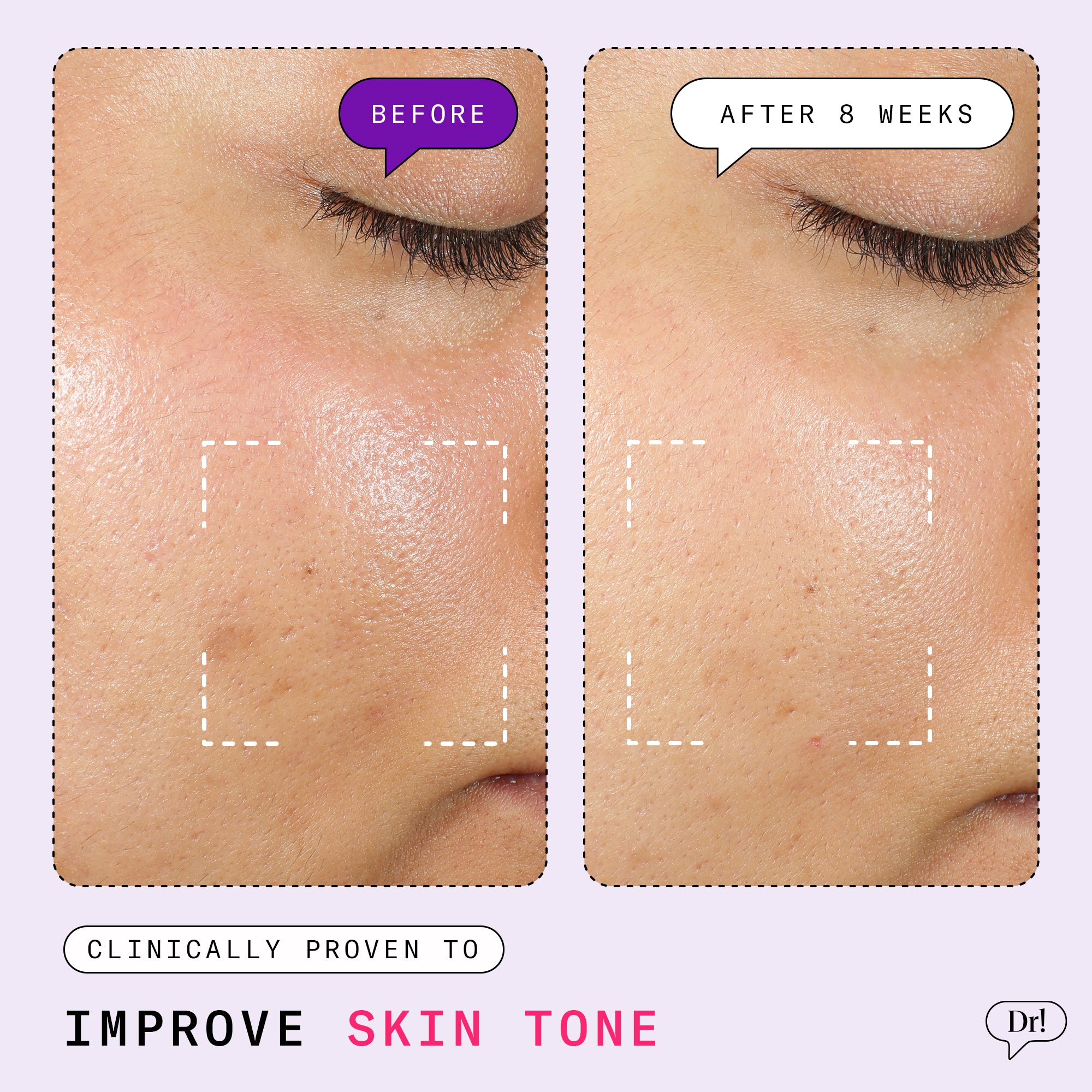 Before and after photos showing improved skin tone with reduced hyperpigmentation after 8 weeks of Dr. Idriss products