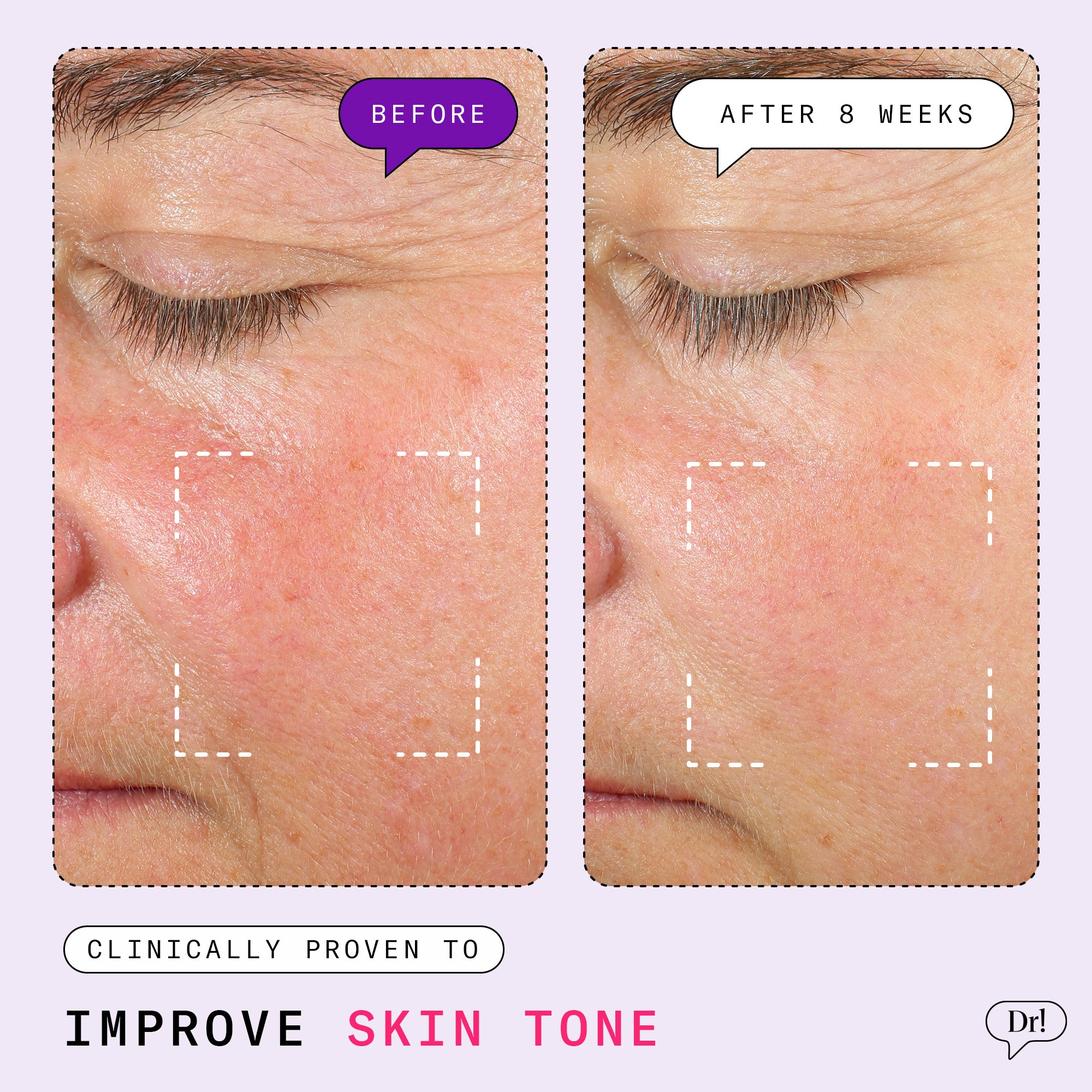 Before-and-after comparison of skin tone, showcasing visibly reduced redness and improved skin tone after 8 weeks of Major Fade System use