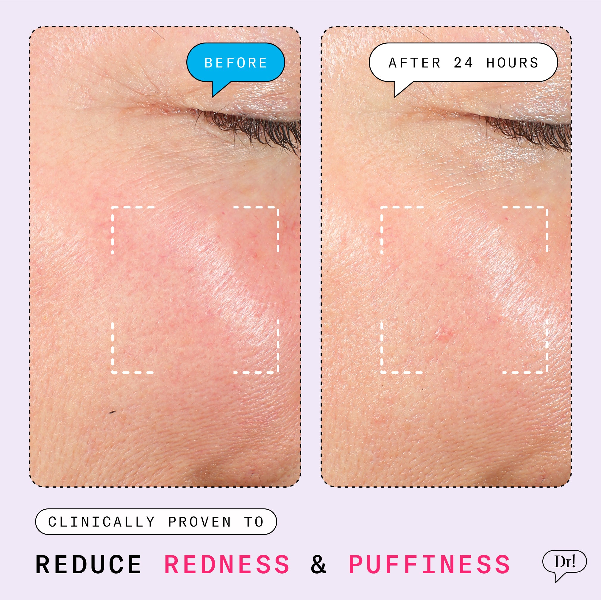 Redness Relief Kit