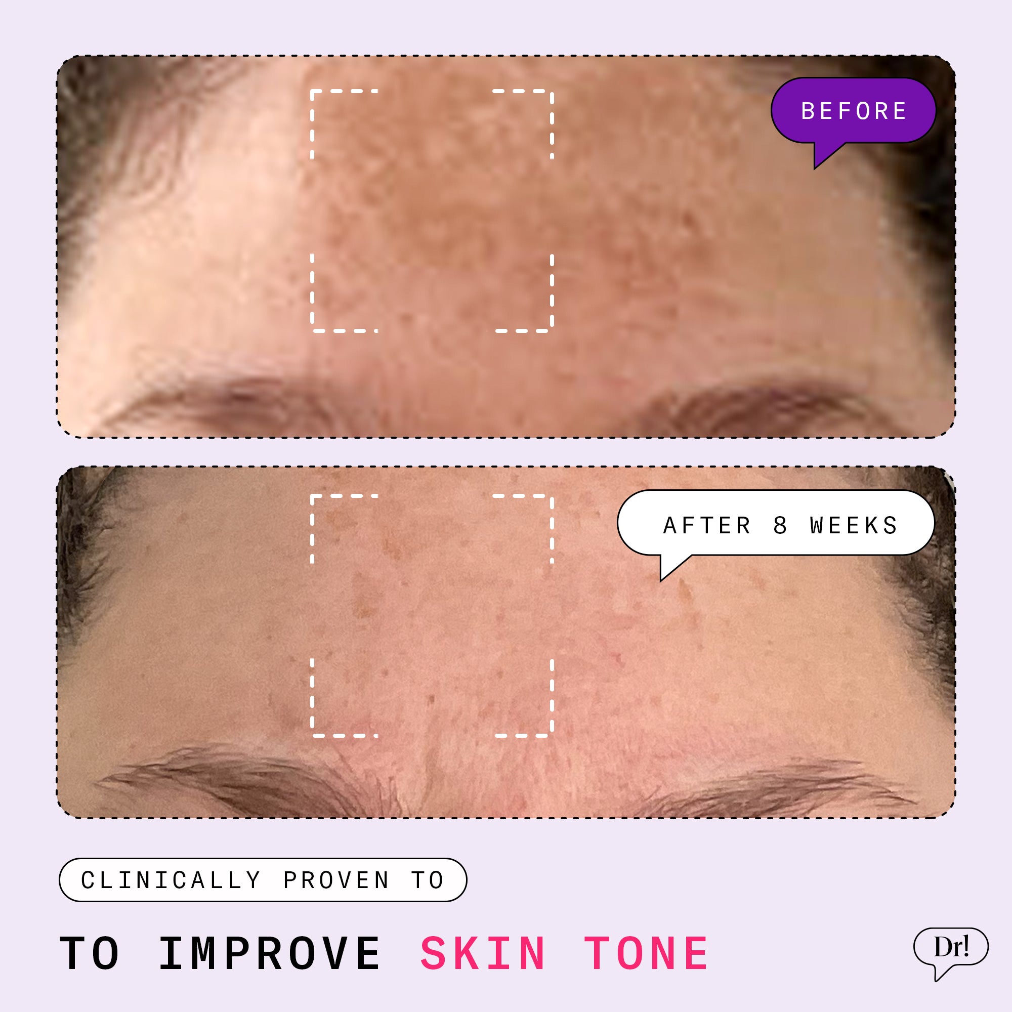 Before and after photos showing improved skin tone with reduced hyperpigmentation after 8 weeks of Dr. Idriss products