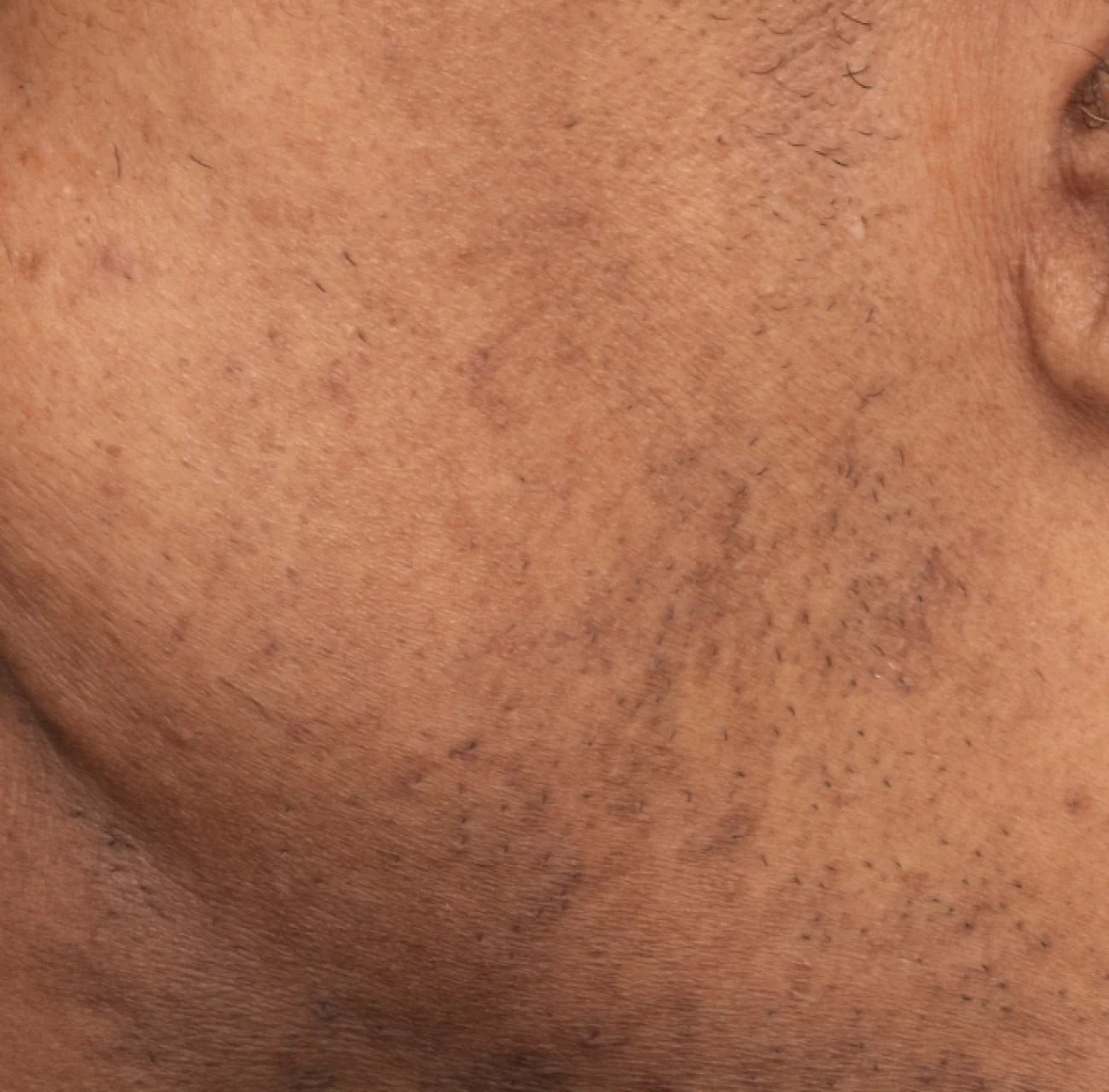 Clinical after results for Dr. Idriss Major Fade Solution System displaying visibly  reduced hyperpigmentation and brighter skin after 8 weeks