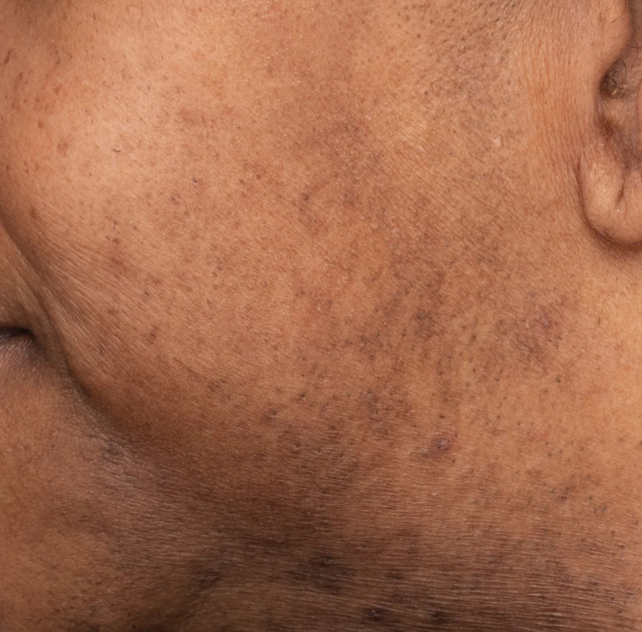 Clinical before results for Dr. Idriss Major Fade Solution System 